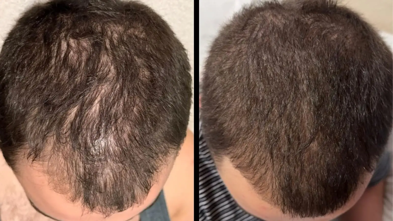 Men’s hair growth treatment improves receding hairline in ‘three months’ and is now only £23