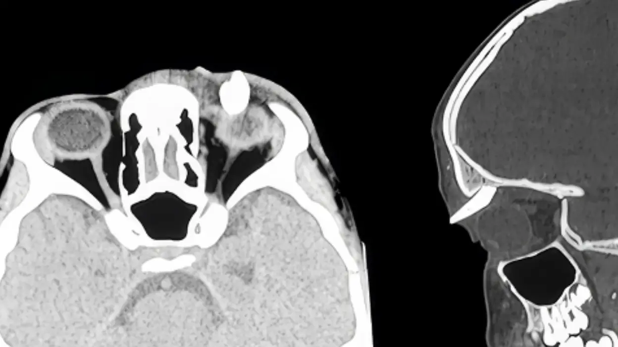 Teenage boy has tooth growing from eye socket in rare case that stunned doctors
