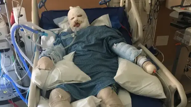 Woman who survived horrific explosion with 40% burns reveals incredible transformation seven years on